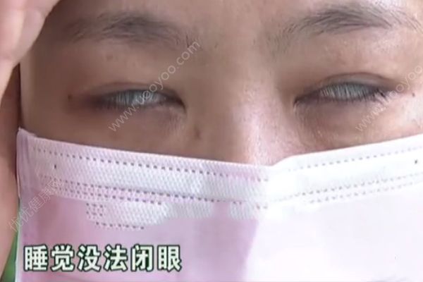 女子做整容手術(shù)后眼睛無法合上！睡覺只能翻白眼貼膠帶！(2)