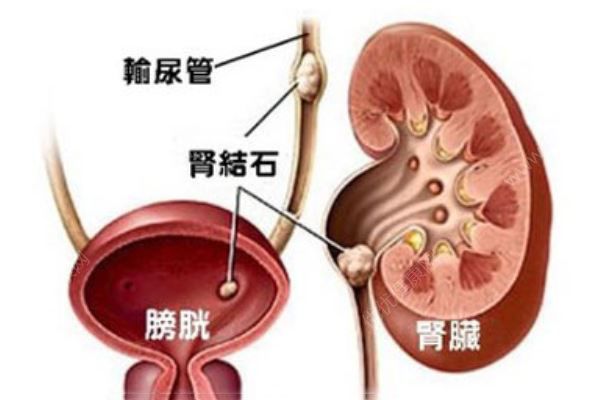 常州一大媽右腎里取出一盆結(jié)石，醫(yī)生一數(shù)，竟有2980顆(2)