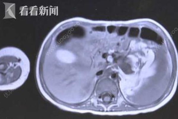 3歲女童腹腔長(zhǎng)直徑約15厘米腫瘤，嬰幼兒腫瘤如何早發(fā)現(xiàn)？(2)