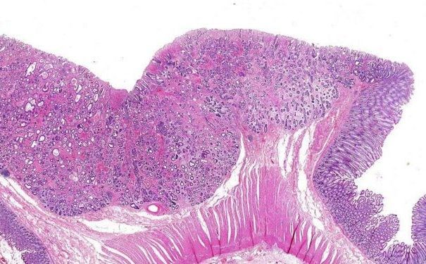 直腸癌有哪些病因？直腸癌有何治療方法？(3)