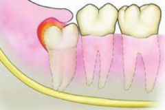 智齒發(fā)炎應(yīng)該怎么辦？智齒很疼該不該拔掉？[多圖]