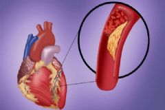 動脈硬化有何癥狀？動脈硬化如何診斷？[圖]