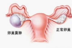 卵巢腫瘤嚴(yán)重嗎？卵巢腫瘤手術(shù)[圖]