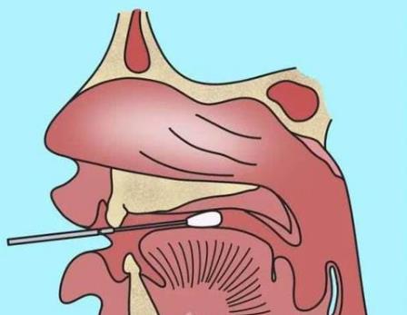 核酸檢測新冠病毒的常用手段：口腔拭子、鼻腔拭子檢測圖示