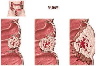 最新！武漢江漢博仕醫(yī)院：腸道篩查做什么檢查