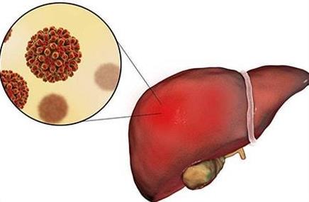 肝病怎么徹底治好？如何預(yù)防肝病