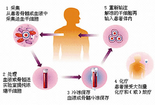 濟(jì)南血液病醫(yī)院科普：骨髓瘤患者自體移植前需要做好哪些準(zhǔn)備？