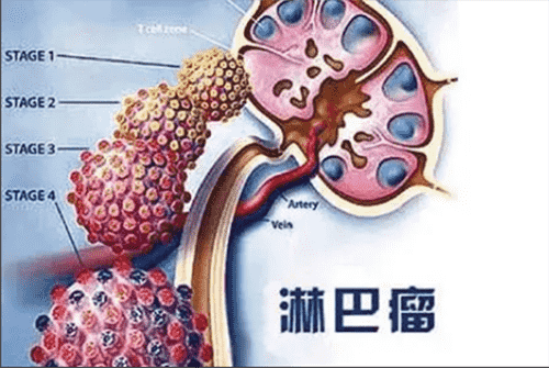 濟南血液病醫(yī)院科普：治療非霍奇金淋巴瘤，化療、移植哪個好？