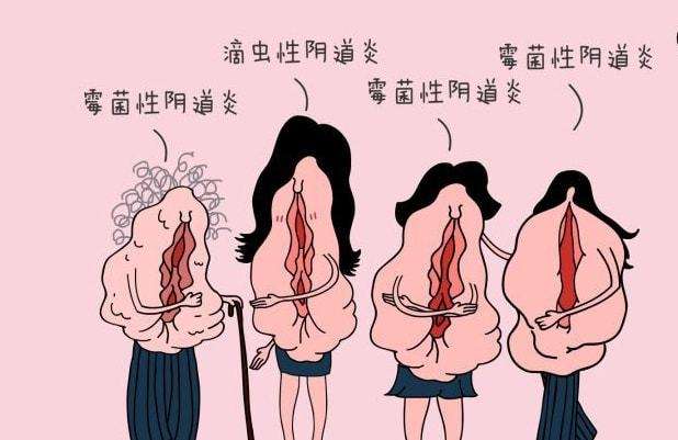 女性在生活中怎樣預(yù)防女性私處炎癥？女性私處炎反復(fù)發(fā)作原因[圖]