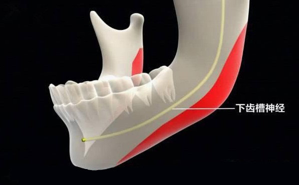 聯(lián)合麗格第一醫(yī)院何照華教授：下頜角手術(shù)會不會損傷神經(jīng)線？