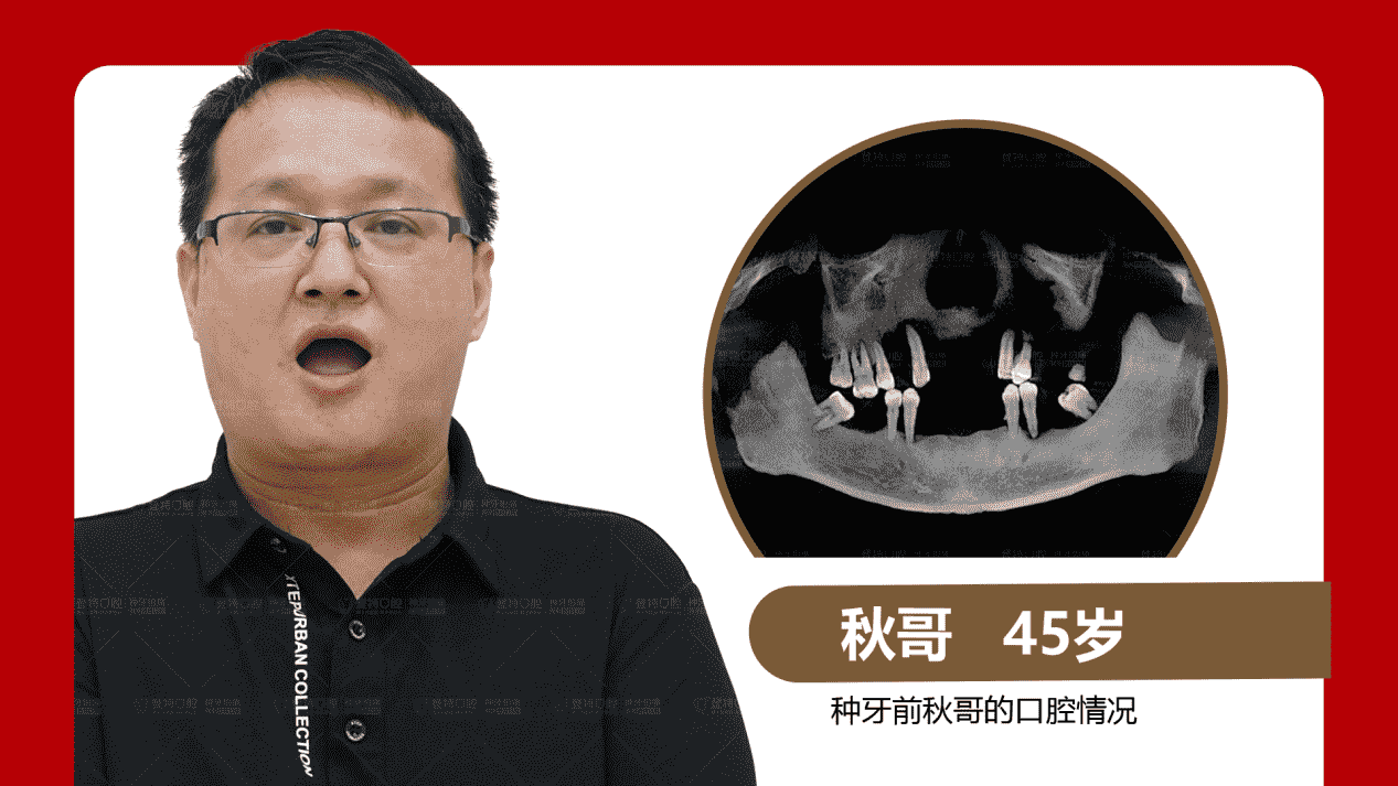 佛山登特口腔：全口半口缺牙修復(fù)方式怎么選？