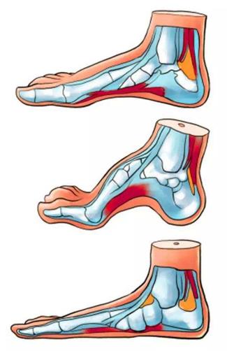 扁平足能跑步嗎？扁平足跑步有什么危害？