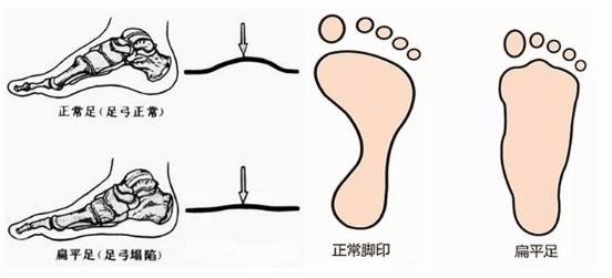 扁平足能跑步嗎？扁平足跑步有什么危害？