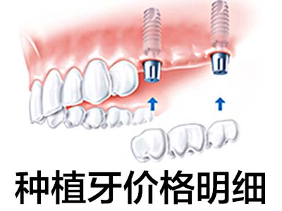 種植槽牙多少錢 天津北辰種植后槽牙多少錢一顆