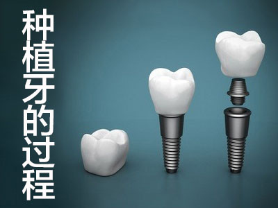 種植牙即刻種植 天津即刻種植牙要多長時間