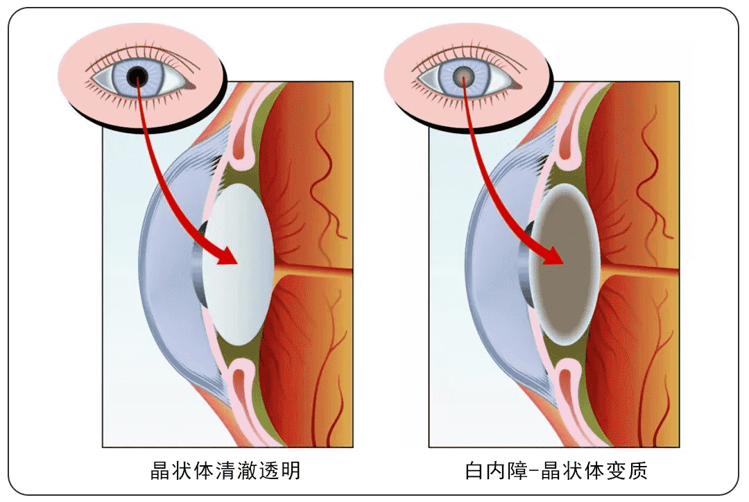 重慶高溫天氣下，普瑞眼科內(nèi)購會護眼福利來襲