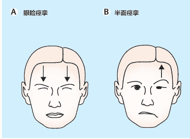 長(zhǎng)安面神經(jīng)醫(yī)院居劍峰：口眼聯(lián)動(dòng)是面肌痙攣嗎