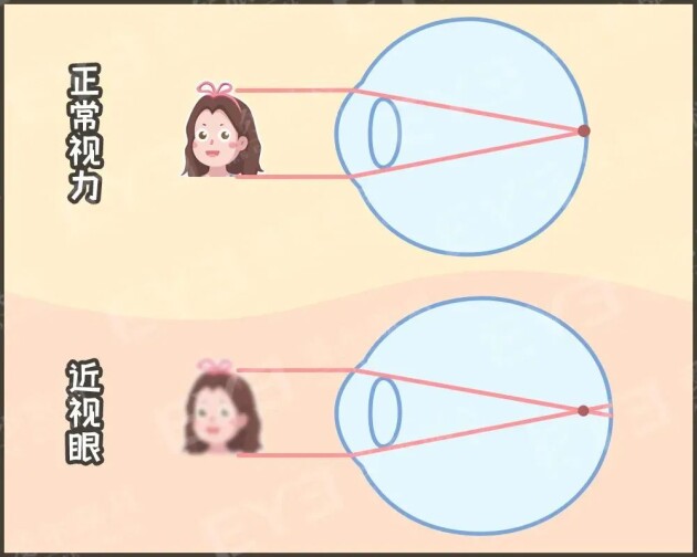 孩子戴上眼鏡度數(shù)會越來越高，確實如此嗎？——合肥愛爾眼科