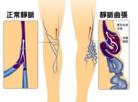 患靜脈曲張如何墊高腿 在腳下墊墊子抬高15度到30度