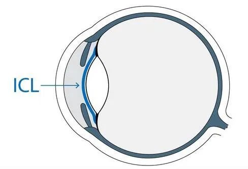 劉保松博士談ICL晶體植入⑤：激光VS晶體植入，糾結控如何選擇？
