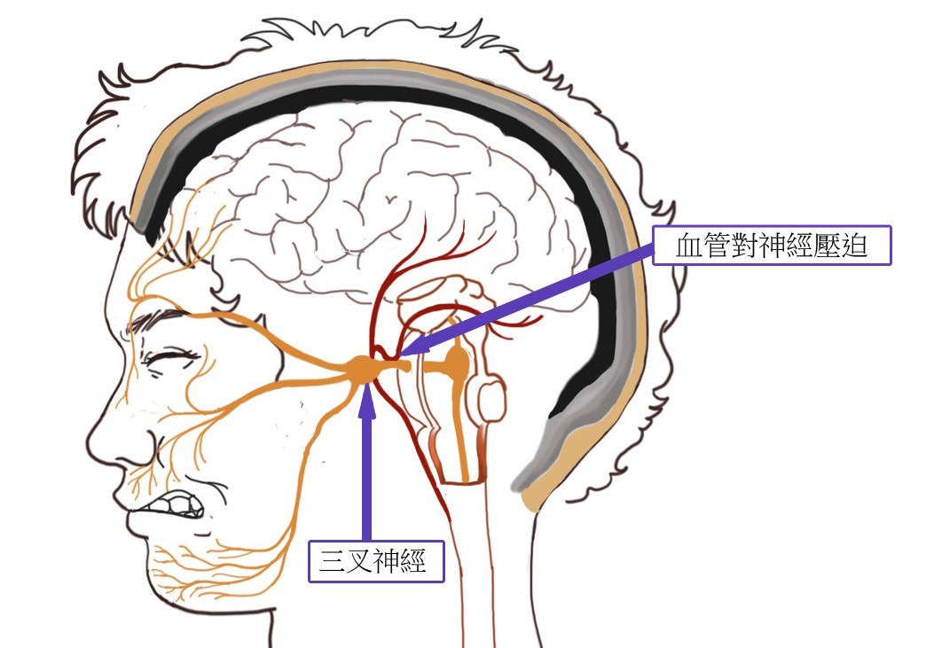 北京廣濟(jì)醫(yī)院好不好，如何治療三叉神經(jīng)痛