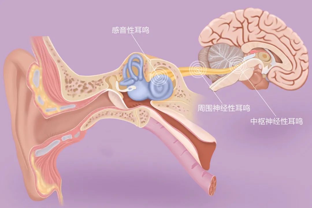 “嚶嚶嚶…”，成都民生耳鼻喉醫(yī)院提醒：耳鳴是身體的警報(bào)，須重視！