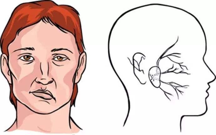 上海健橋醫(yī)院好不好，面癱的兩種常見癥狀和治療方法