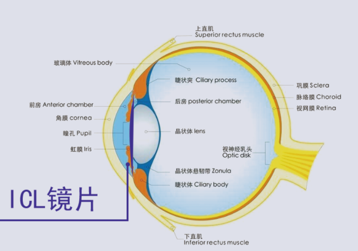  ICL晶體植入術(shù)貴在哪里？合肥普瑞眼科專家來解答（近視手術(shù)鉅惠來襲）