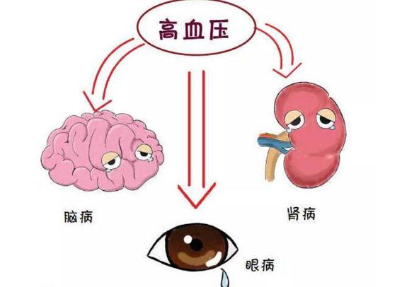 高血壓有哪幾種類型？高血壓要做些什么檢查項目？