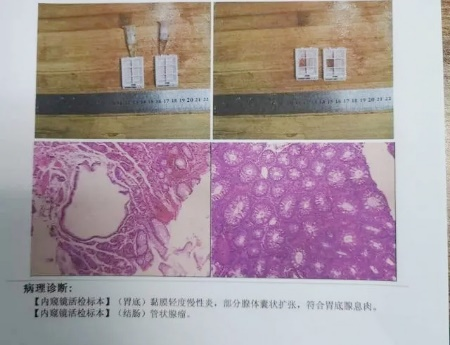 廣州東大肛腸醫(yī)院好不好34歲女士腸息肉切除后3年不查，拖出腸癌