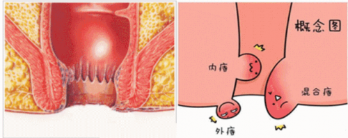 廣州東大肛醫(yī)院這樣區(qū)分內(nèi)痔外痔混合痔可信嗎？