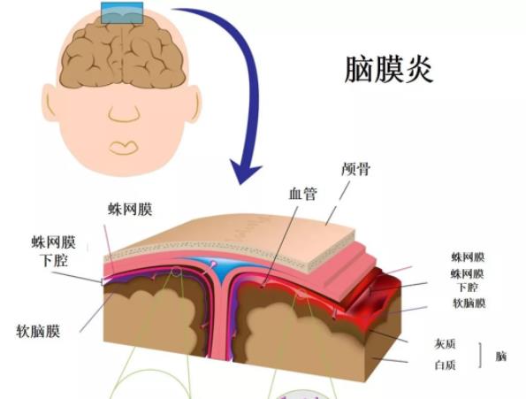 腦膜炎是怎么引起的 各種化膿性細菌感染