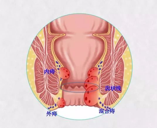 痔瘡之痛何以解，揚州妙手肛腸醫(yī)院為痔瘡病友解決“難言之苦”