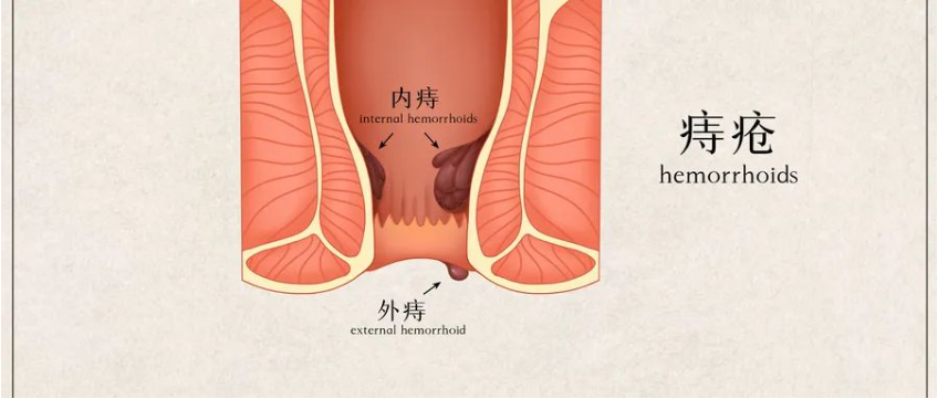 【北京豐益肛腸醫(yī)院】導致炎性外痔的主要原因有哪些？