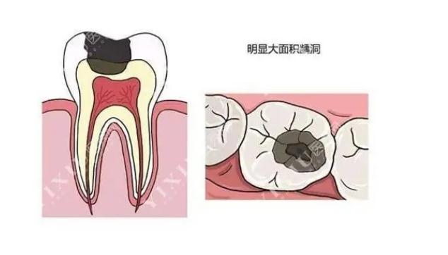 牙齒有洞不補會怎樣？牙齒有洞為什么一定要補？