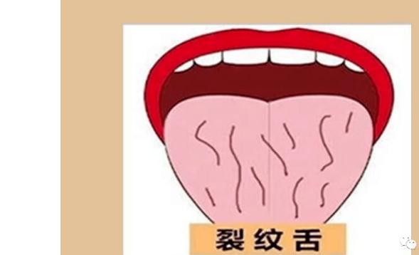 舌頭有裂紋是怎么回事？舌頭有裂紋要治療嗎？