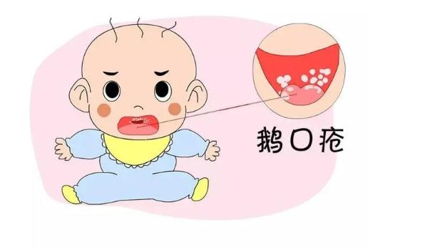 鵝口瘡是怎么引起的？寶寶得鵝口瘡怎么護(hù)理？