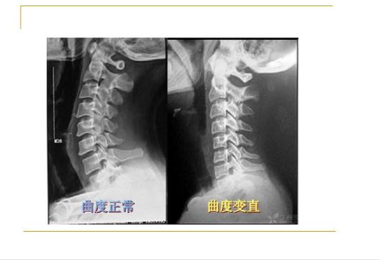 頸椎病能引起后背疼嗎？頸椎病的鑒別診斷有哪些？