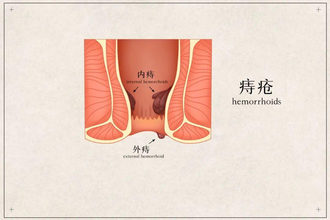 包頭東大肛腸?？漆t(yī)院詳解便血是怎么回事？