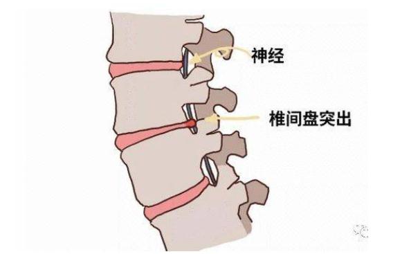 腰間盤突出吃什么藥？腰間盤突出能治愈嗎？