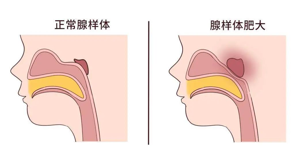 為什么現(xiàn)在患腺樣體肥大的孩子越來(lái)越多？聽聽成都民生耳鼻喉醫(yī)院怎么說(shuō)