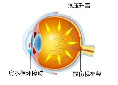 【合肥愛爾】青光眼嚴(yán)重嗎？它可能會致盲！