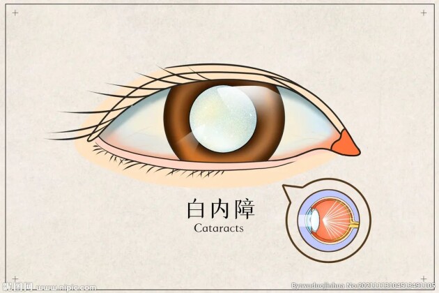 眼前好像蒙了一層霧，是白內(nèi)障嗎？這5大癥狀，轉(zhuǎn)發(fā)給父母自查——福州愛(ài)爾