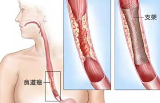 食道癌早期有哪些癥狀 食道癌早期能治好嗎