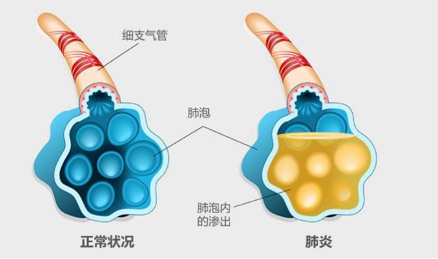 流感疫苗可以預(yù)防肺炎嗎 ？支原體肺炎更易侵襲小學(xué)生嗎？