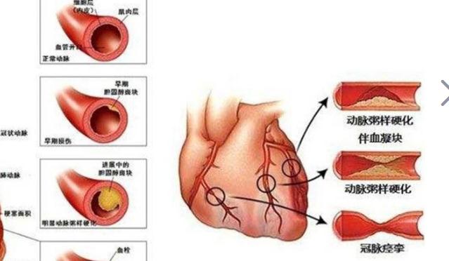 冠心病吃什么好？治療冠心病要多少錢？