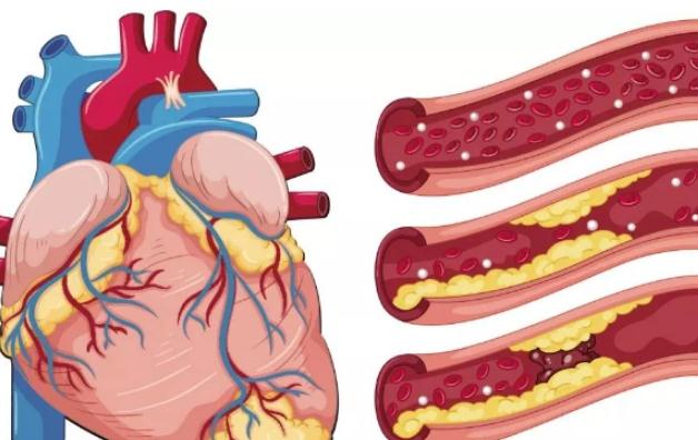 冠心病預(yù)防與保健 ？冠心病的分類？