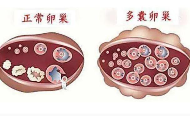 樣預防多囊卵巢？多囊為什么肚子大？