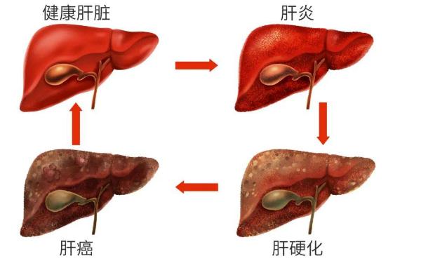 肝硬化可以治好嗎？肝硬化并發(fā)癥？