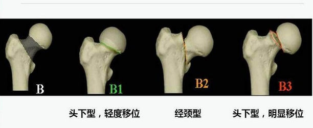 股骨頭壞死早期有效治愈方法迎來全新進(jìn)展，中成藥將是關(guān)鍵